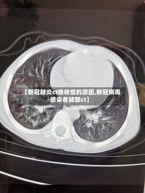 【新冠肺炎ct吸收慢的原因,新冠病毒感染者肺部ct】-第3张图片
