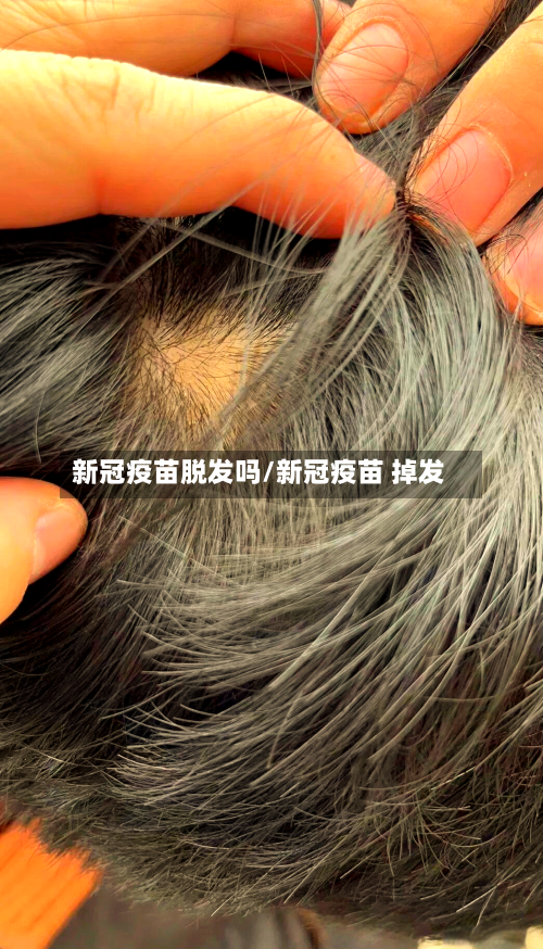 新冠疫苗脱发吗/新冠疫苗 掉发